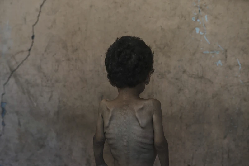 Yazan Abu Ful, uma criança desnutrida de 2 anos, posa para uma foto em sua casa no campo de refugiados de Shati, na Cidade de Gaza, na quarta-feira, 23 de julho de 2025. (AP Photo/Jehad Alshrafi)